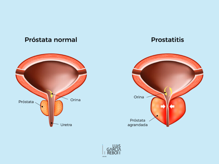 Prostatitis tipos de infecciones prostáticas, síntomas