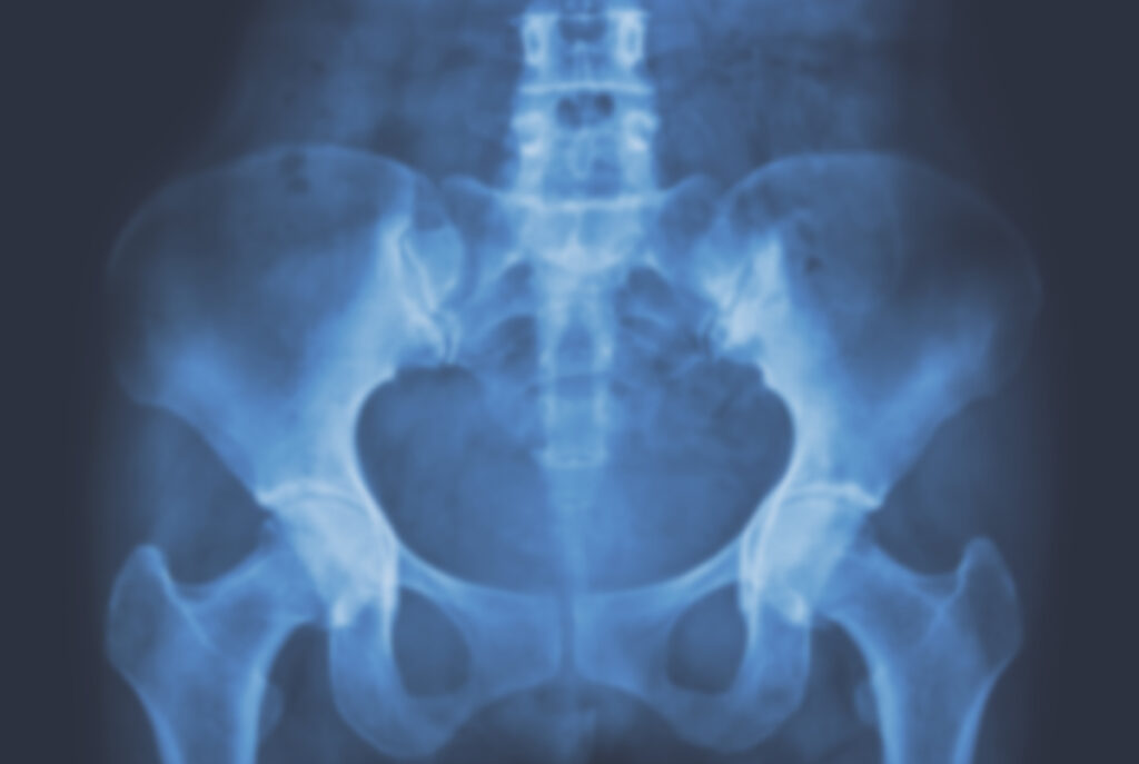 Tumor de pelvis renal y uréter