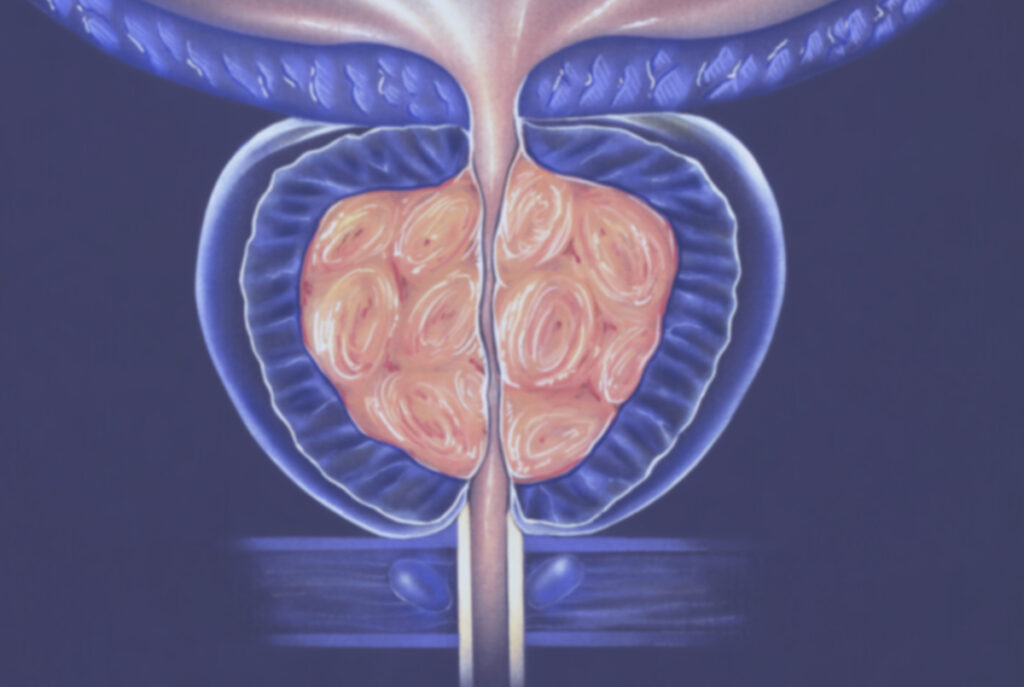 Hiperplasia benigna de próstata (HBP)